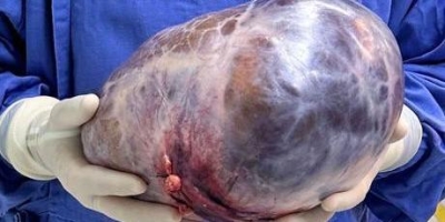 Tumor de 5 quilos é retirado do ovário de mulher em Juiz de Fora